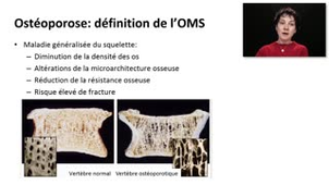 ECN 124 - Ostéopathies fragilisantes