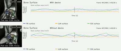 Bone Surface Variation With vs. Without GWMD (CORO)