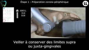 Préparation et réalisation d'un inlay-core sur une dent pluriradiculée par méthode directe