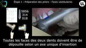 Préparations corono-périphériques pour prothèse fixée plurale sur dents contiguës