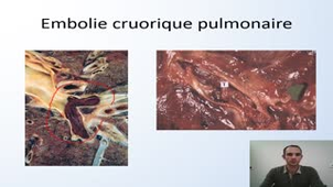 AnaPath UE1 FGSM2 - 07 - Pathologie vasculaire - Partie 2 - UE1 FGSM2 2020 - G Gauchotte