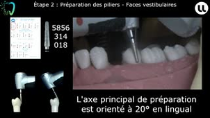 Préparation d'une prothèse plurale corono-périphérique avec extension mésiale (cantilever)