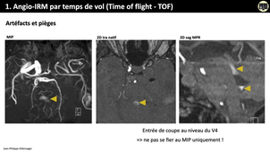 4.4a Angiographie par temps de vol.mp4