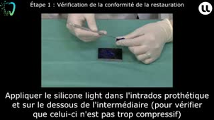 Assemblage d'une restauration prothétique à l'aide d'un ciment de scellement