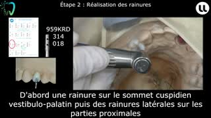 Restaurations partielles collées sur dents dépulpées type 