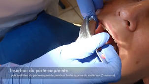 Empreinte prothèse fixée technique double mélange