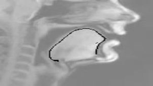 Autoencoding tracking of the tongue contour in a vocal tract MRI film