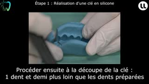 Réalisation d'un bridge postérieur avec intermédiaire Technique de l'isomoulage direct