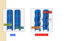 ECN 225 - Insuffisance veineuse chronique