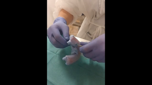 Empreinte implantaire technique pick up