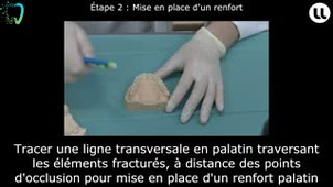 Réparation d'un bridge transitoire
