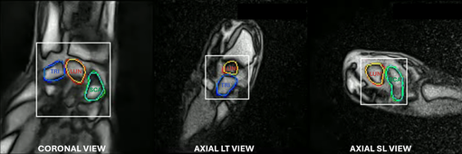 Automatic Carpal Bone Segmentation (CORO / LT / SL)
