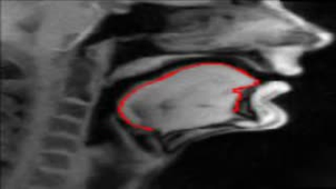 CNN delineation of the tongue on a MRI film