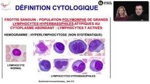 ECN 213 - Syndrome mononucléosique