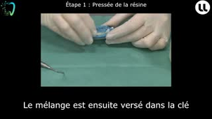 Réalisation d'un bridge antérieur avec intermédiaire Technique de l'isomoulage direct et corrections des erreurs