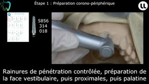 Préparation et réalisation d'un inlay-core sur dent monoradiculée par méthode directe et transitoire à tenon