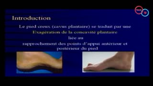 50 Pied creux chirurgical	(Dr A. Nespola)