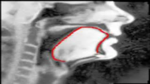 CNN tongue delineation S1