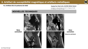 4.2c Artéfacts Susceptibilité magnétiques et métalliques.mp4