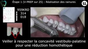 Restaurations partielles collées Préparation pour V-PREP et overlay