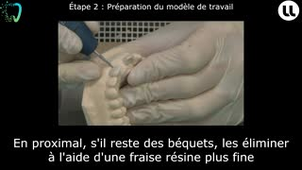 Prothèse fixée plurale avec intermédiaire Préparation corono-périphérique en secteur antérieur