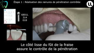 Préparation pour facettes maxillaires