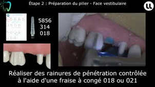 Réalisation d'un bridge postérieur avec intermédiaire - Préparation corono-périphérique sur secteur postérieur