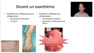 ECN 160 - Exanthèmes fébriles de l'enfant
