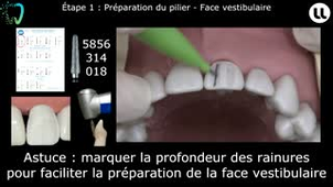 Préparation corono-périphérique unitaire sur dent antérieure