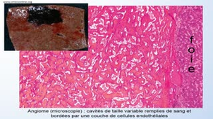 UE13 App. Dig. FGSM2 - Ana Path - 3. Pathologie tumorale B foie VB et pancréas - G Gauchotte 2020