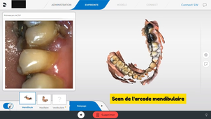 Réalisation d'une empreinte optique pour reconstitution corono-radiculaire