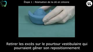 Réalisation d'un transitoire en résine en méthode indirecte : Méthode de la coquille