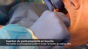 Empreinte prothèse fixée wash technique